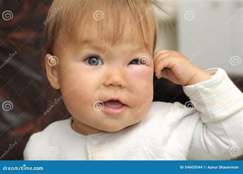 Baby with a Swollen Eye from an Insect Bite Stock Photo - Image of ...