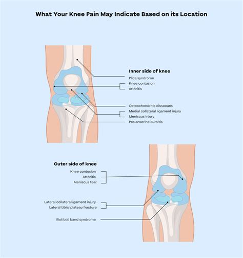 Knee Pain Location Chart: Understanding Inner Knee Pain