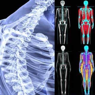 DEXA Scan | Bone Density Test | AIOR | Patna