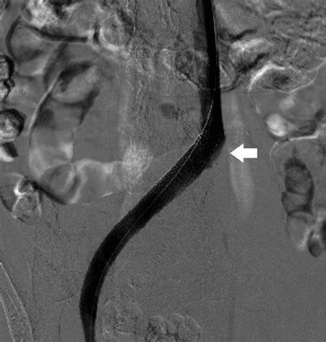 May-Thurner Syndrome | Circulation