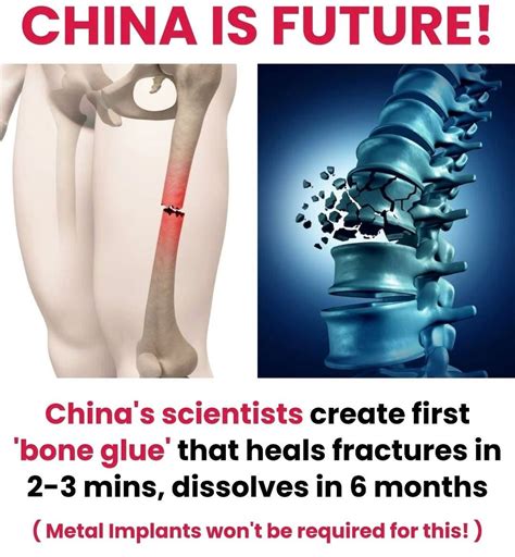 Revolutionary "Bone Glue" bonds shattered bones in 3 minutes: China's ...