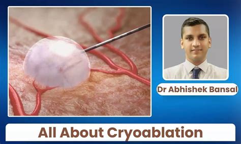 Healing with Cold: What to Know About Cryoablation - Dr Abhishek Bansal