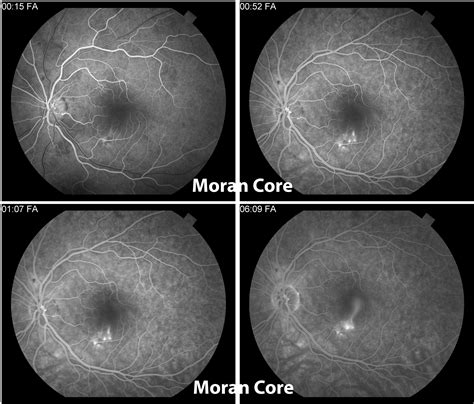 Central Serous Retinopathy