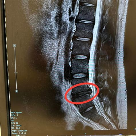 Asked my doctor how long till this may heal and he told me "No, this is ...