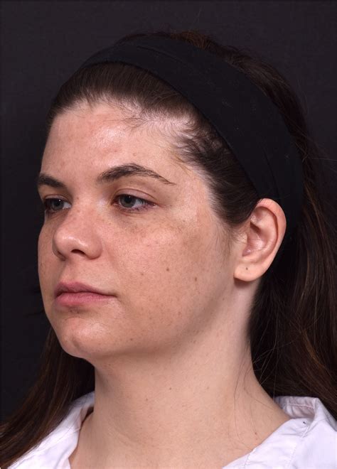 Buccal Fat Reduction Case 19147