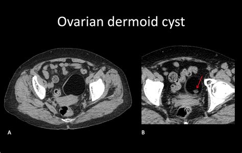 Ovarian Dermoid Cyst