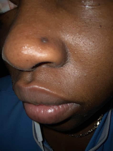 How To Get Rid Of Nose Scars at Robert Suarez blog