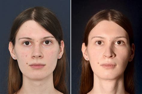 Facial Feminization Jaw Surgery at Jane Mcgary blog
