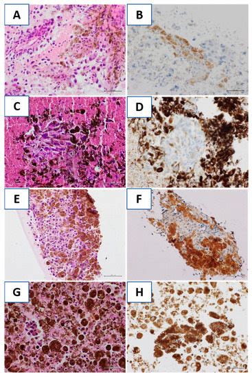 Predictive Evaluation on Cytological Sample of Metastatic Melanoma: The ...