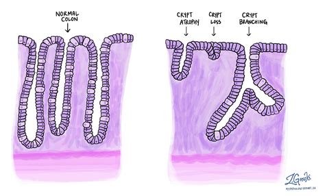 Cryptvervorming - MyPathologyReport
