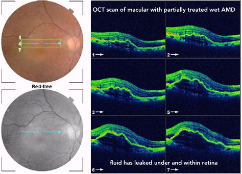Dry Vs Wet Macular Degeneration