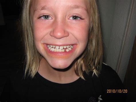 Image result for Lost Tooth