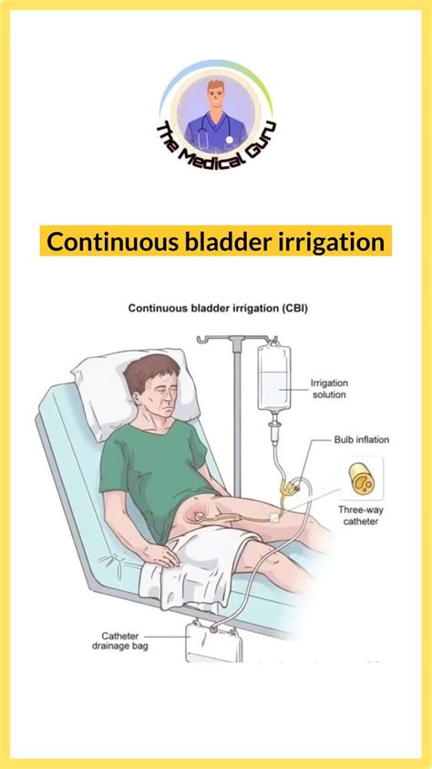 Medical Guru🥼💊 | 👇🏻👇🏻READ CAPTION 👇🏻👇🏻 Continuous bladder irrigation ...