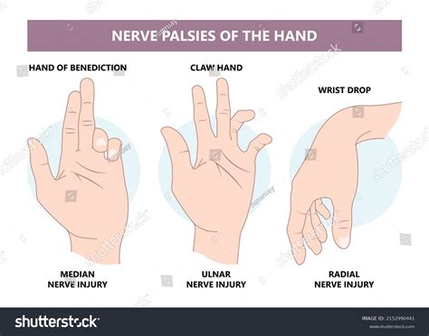 Median Nerve Palsy