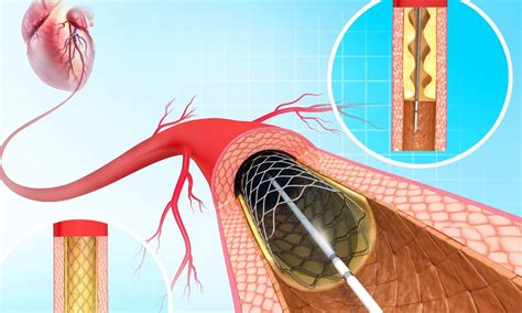 Depression lowers medications adherence after percutaneous coronary ...