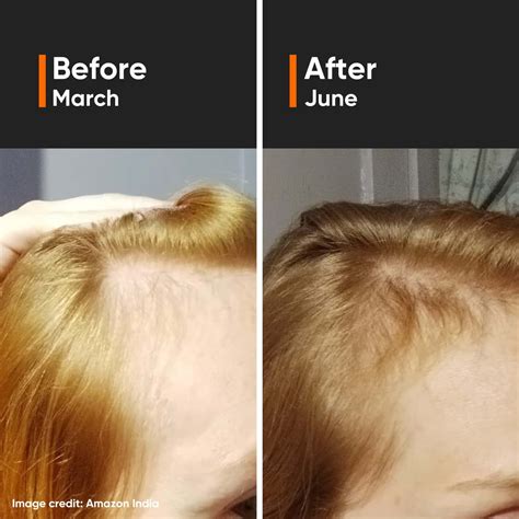 Buy MINIMALIST HAIR GROWTH ACTIVES 18% HAIR SERUM (30ML) Online & Get ...