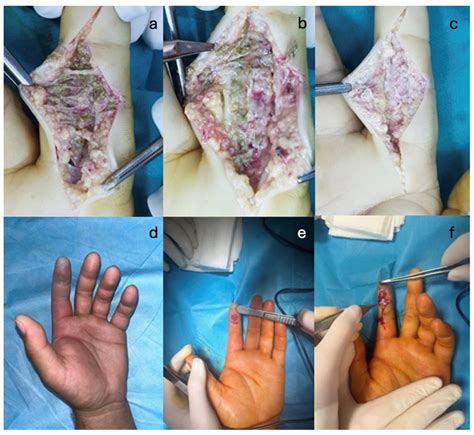 High-Pressure Injection Injury of the Hand—A Rare but True Surgical ...