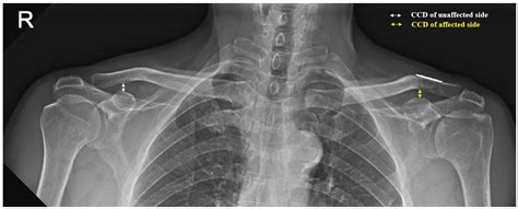 Progressive Loss of Acromioclavicular Joint Reduction Correlated with ...