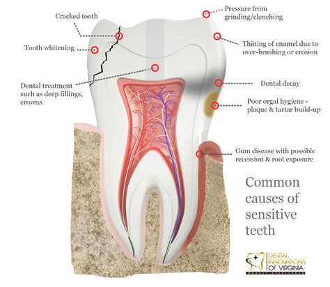 Sensitive Teeth or Sensitive Gum? - Lansdowne, VA Family Dentistry