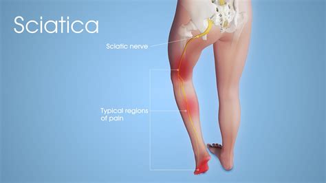 Sciatica: Causes, Pathophysiology, Management and Treatment
