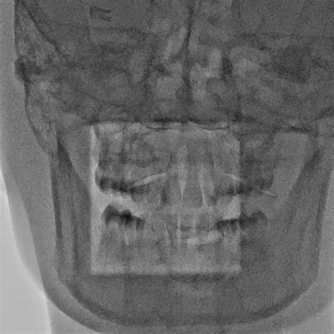 Canon Alphenix BiPlane купити в Україні | InMed