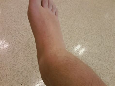 Broken Ankle - Symptoms, Recovery time, Pictures, Surgery, Treatment ...
