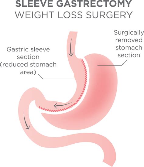 Vertical Sleeve Gastrectomy