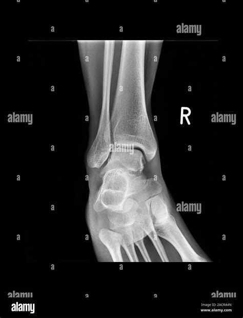Ankle bone fracture. X-ray of the ankle of a patient with a fractured talus (ankle bone, lower ...