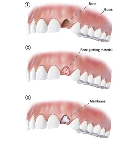 Bone Grafting For Dental Implants in Delhi | Bone Grafting Surgeons in ...