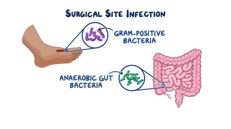Surgical Wound Infection