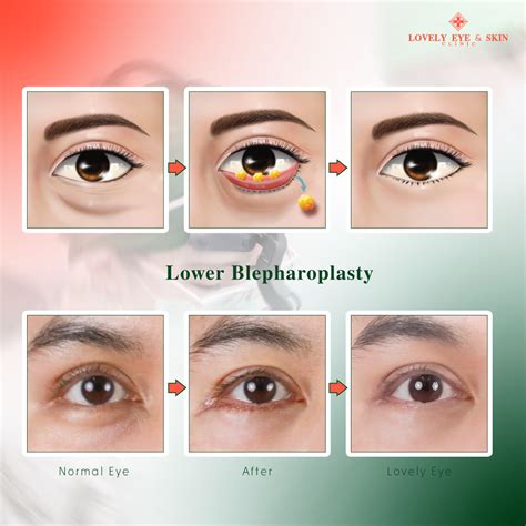 Lower Eyelid Blepharoplasty Recovery (Eye bag surgery)