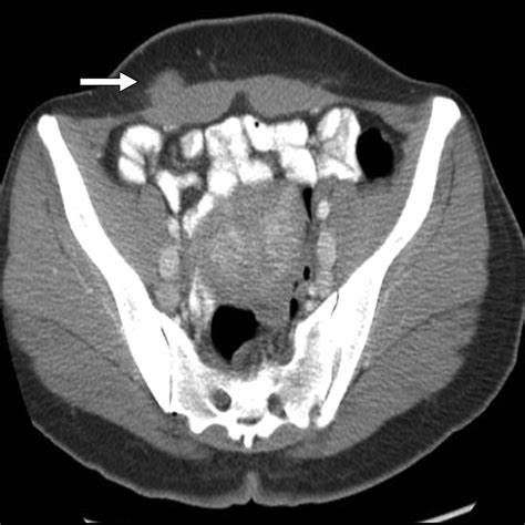 Subcutaneous Abdominal Wall Masses: Radiological Reasoning | AJR
