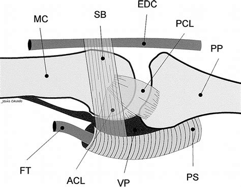 The critical corner - volar plate, proper collateral ligament ...