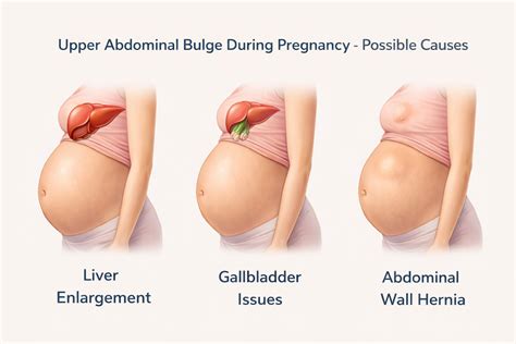 Upper Abdominal Bulge or Lump Above the Belly Button: Causes, Symptoms