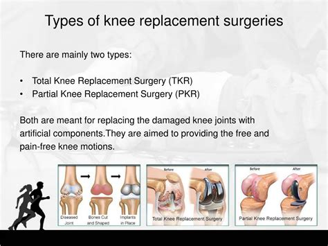 What Are The Different Types Of Total Knee Replacements at Anita Sosebee blog