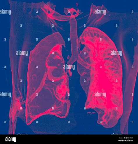 Coloured 3D computed tomography (CT) scan of the chest of a 60 year old ...