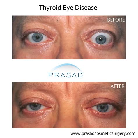 Graves Disease Eyes Treatment