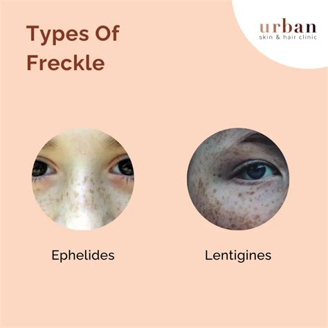 Freckles Types, Causes, Symptoms & Treatment | USHC