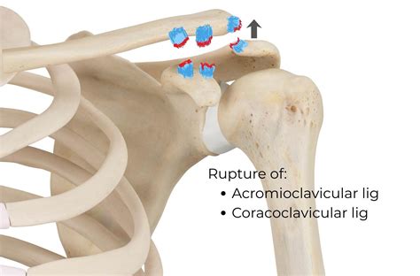 Acromioclavicular (AC) Joint Subluxation and Dislocation: Types, Symptoms,