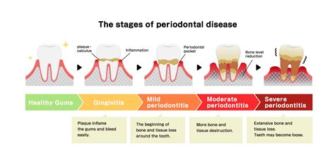 Early Periodontal Disease
