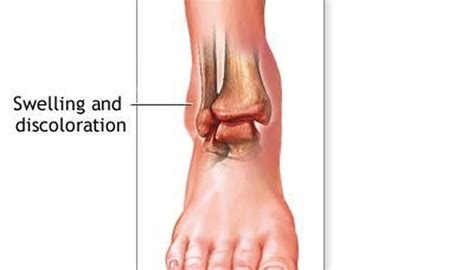 How Long Does a Sprained Ankle Take to Heal? | SportsRec