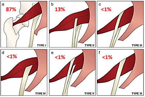 Variant Sciatic Nerve Anatomy in Relation to the Piriformis Muscle on ...