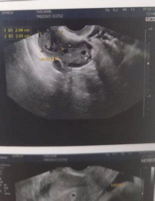 Suspeita de gravidez ectópica e depois ficou tudo bem? | BabyCenter