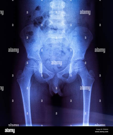 Pelvic bones hi-res stock photography and images - Alamy
