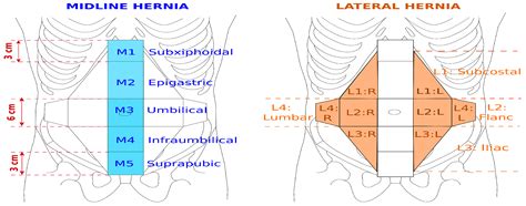Computational Analysis and Classification of Hernia Repairs