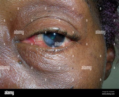 Shingles On Eye