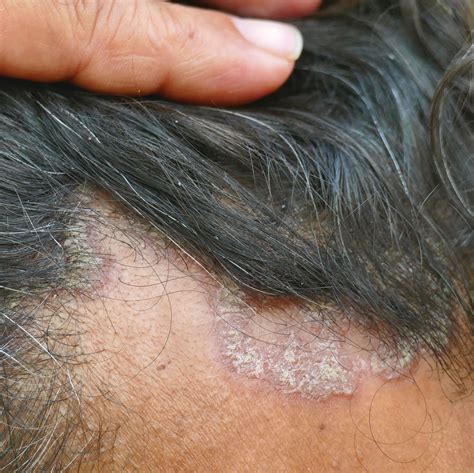 Circular Rashes That Aren’t Ringworm, According to Doctors