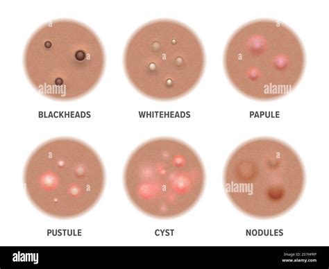 Acne types on dark skin, face pimples and comedones, vector blackheads and pore cysts. Skin acne ...