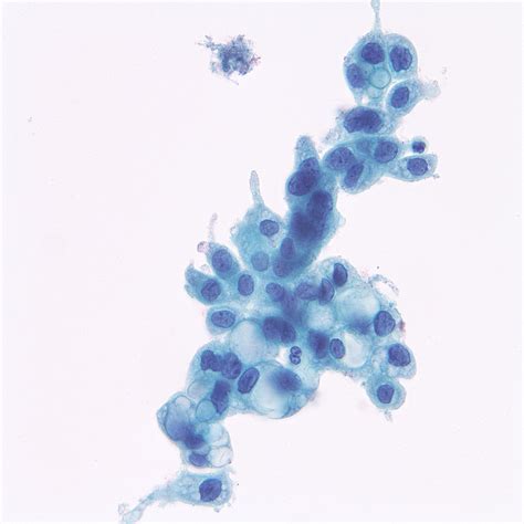 Fig. 2.46 Negative for intraepithelial lesion or malignancy (NILM). Reactive cellular changes ...