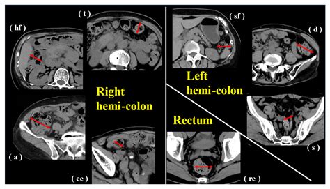Correlation between Constipation Symptoms and Abdominal CT Imaging: A Cross-Sectional Pilot Study